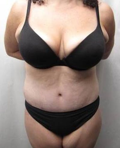Lower Body Lift Before & After Gallery - Patient 229812 - Image 2 - Scott Chapin, MD