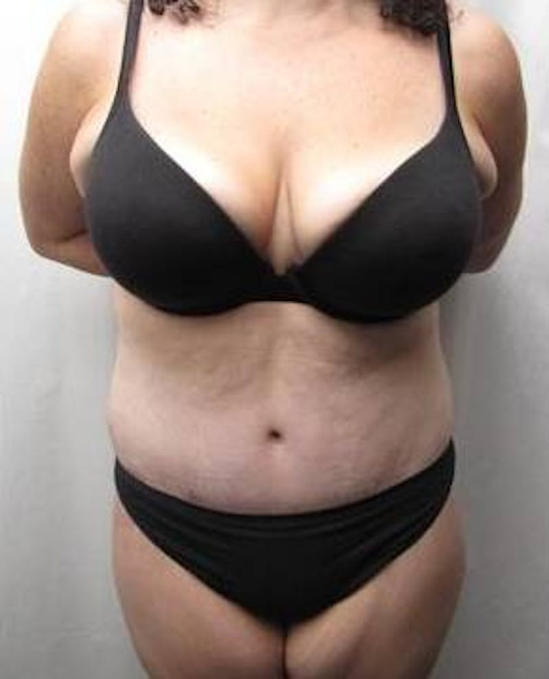Lower Body Lift Before & After Gallery - Patient 229812 - Image 2 - Scott Chapin, MD