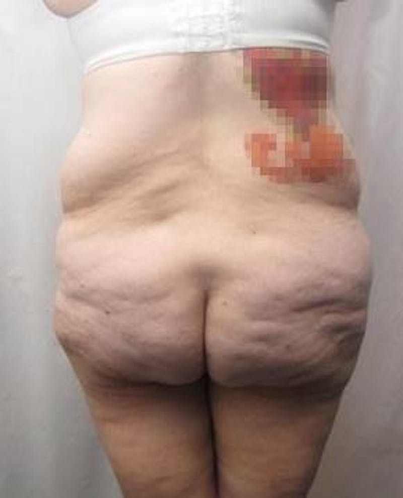 Lower Body Lift Before & After Gallery - Patient 229812 - Image 3 - Scott Chapin, MD
