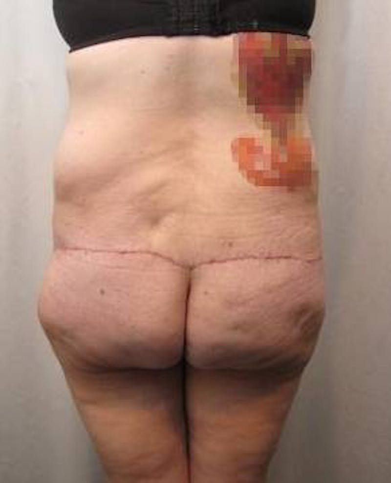 Lower Body Lift Before & After Gallery - Patient 229812 - Image 4 - Scott Chapin, MD