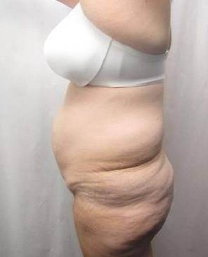 Lower Body Lift Before & After Gallery - Patient 229812 - Image 5 - Scott Chapin, MD