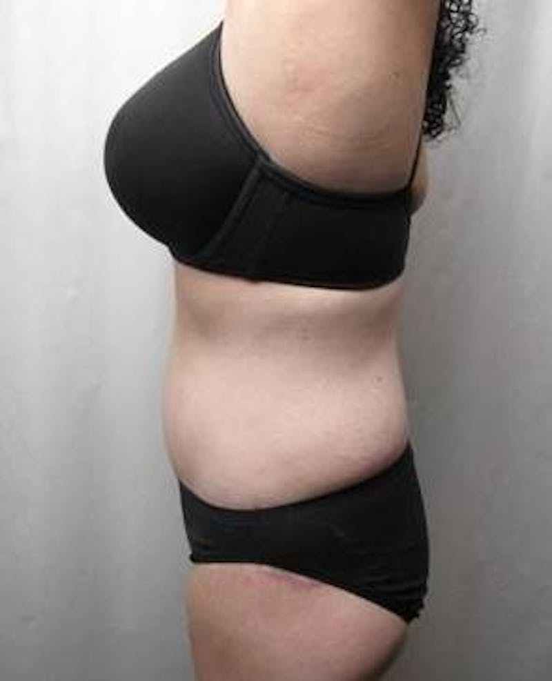 Lower Body Lift Before & After Gallery - Patient 229812 - Image 6 - Scott Chapin, MD