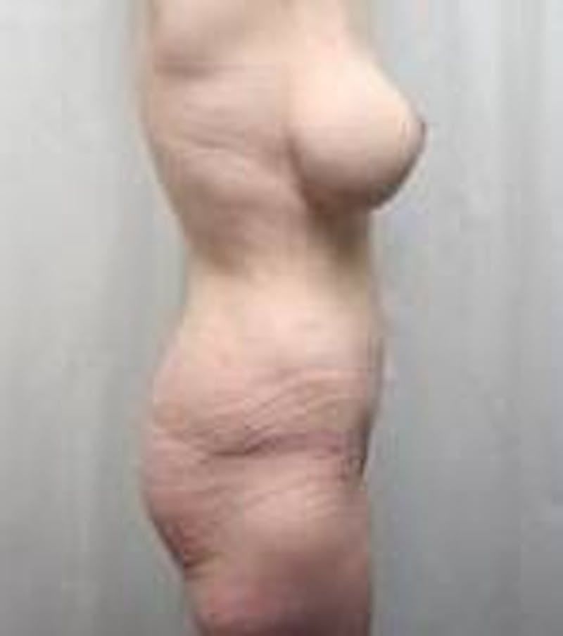 Lower Body Lift Before & After Gallery - Patient 294053 - Image 4 - Scott Chapin, MD