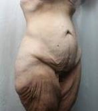Lower Body Lift Before & After Gallery - Patient 178124 - Image 1 - Scott Chapin, MD
