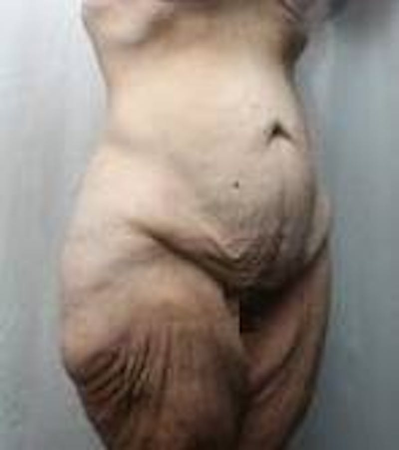 Lower Body Lift Before & After Gallery - Patient 178124 - Image 1 - Scott Chapin, MD