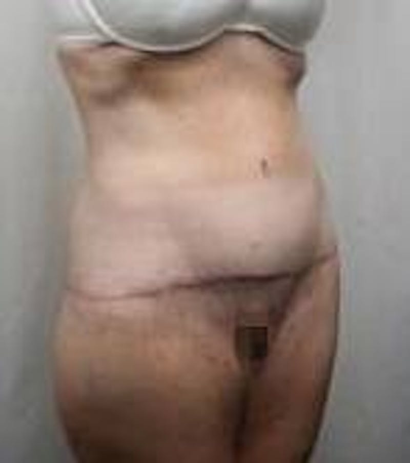Lower Body Lift Before & After Gallery - Patient 178124 - Image 2 - Scott Chapin, MD