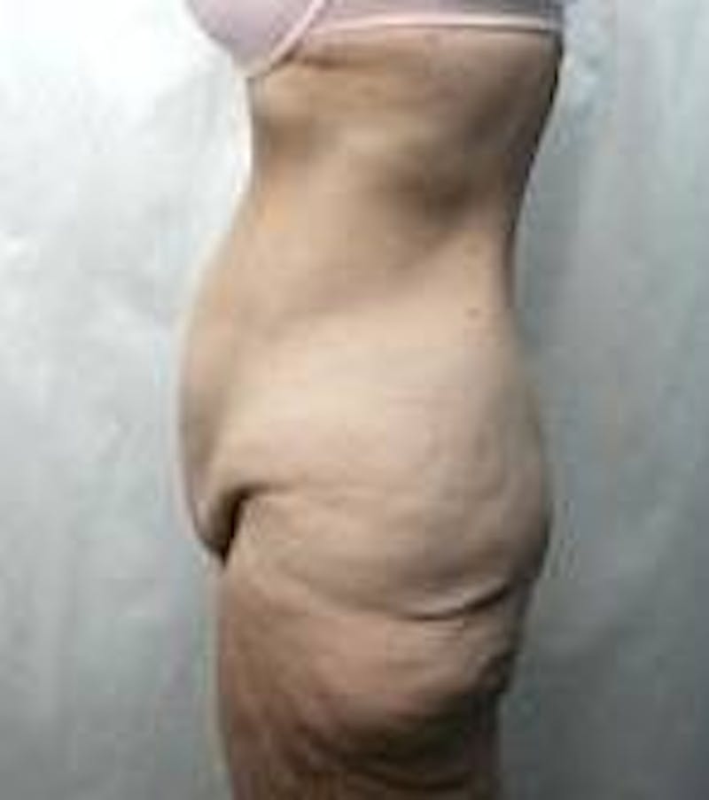 Lower Body Lift Before & After Gallery - Patient 178124 - Image 3 - Scott Chapin, MD