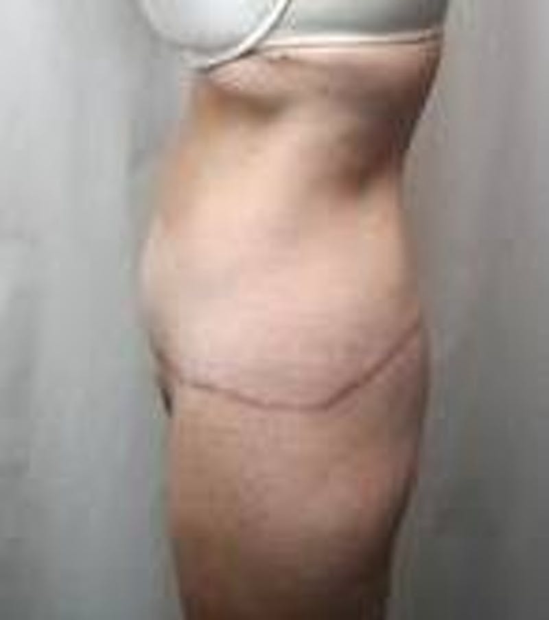 Lower Body Lift Before & After Gallery - Patient 178124 - Image 4 - Scott Chapin, MD