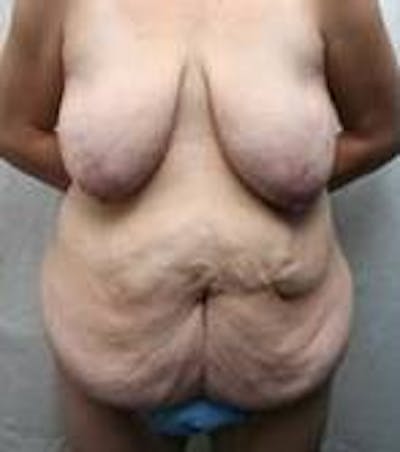 Lower Body Lift Before & After Gallery - Patient 191126 - Image 1 - Scott Chapin, MD