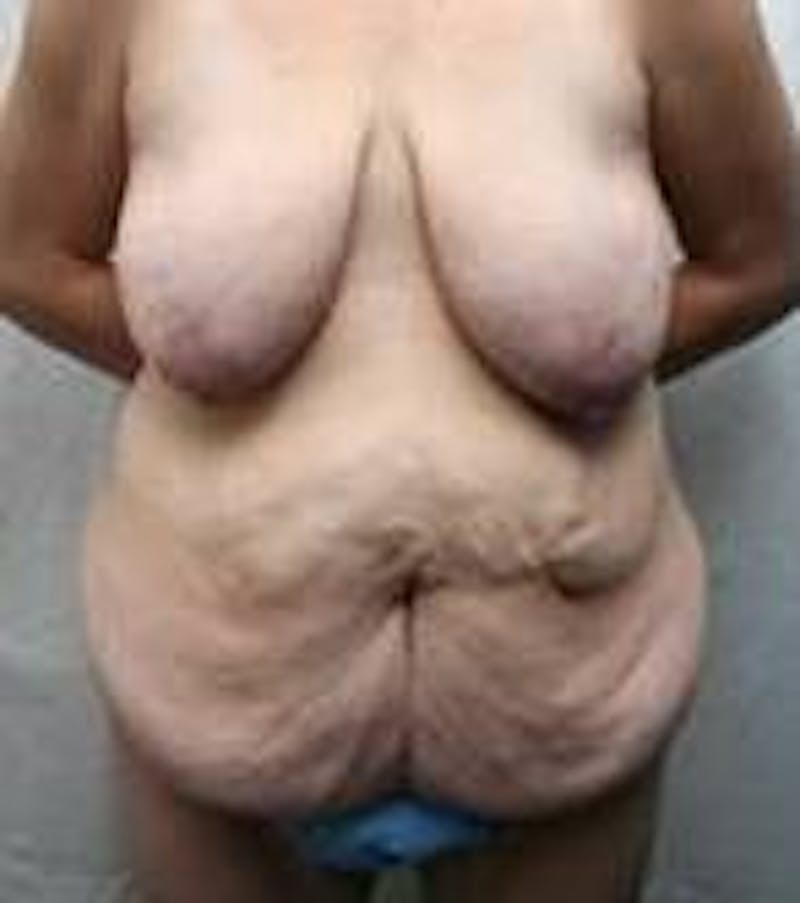 Lower Body Lift Before & After Gallery - Patient 191126 - Image 1 - Scott Chapin, MD