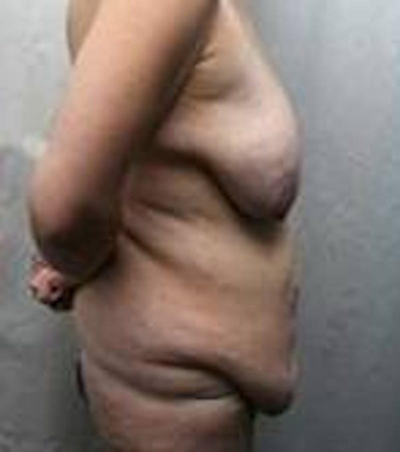 Lower Body Lift Before & After Gallery - Patient 191126 - Image 3 - Scott Chapin, MD