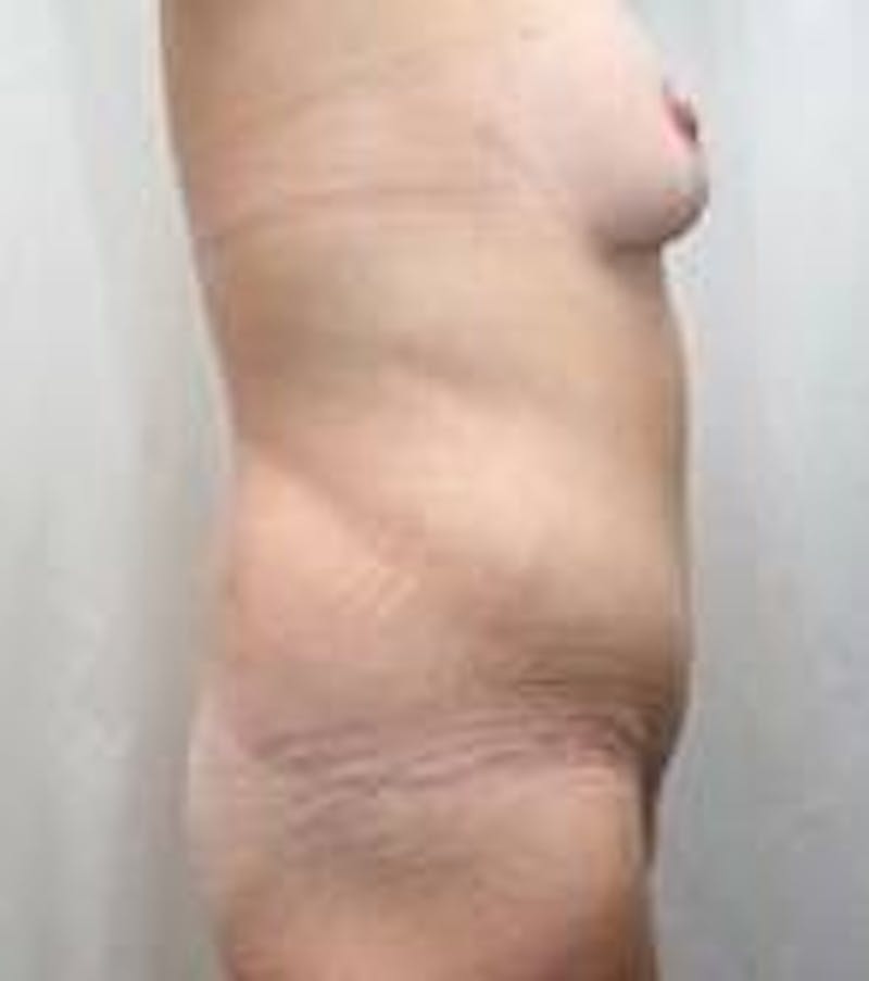 Lower Body Lift Before & After Gallery - Patient 191126 - Image 4 - Scott Chapin, MD