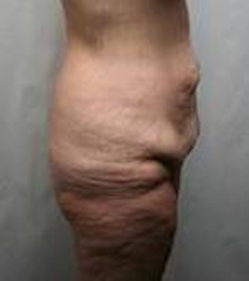 Lower Body Lift Before & After Gallery - Patient 272007 - Image 3 - Scott Chapin, MD