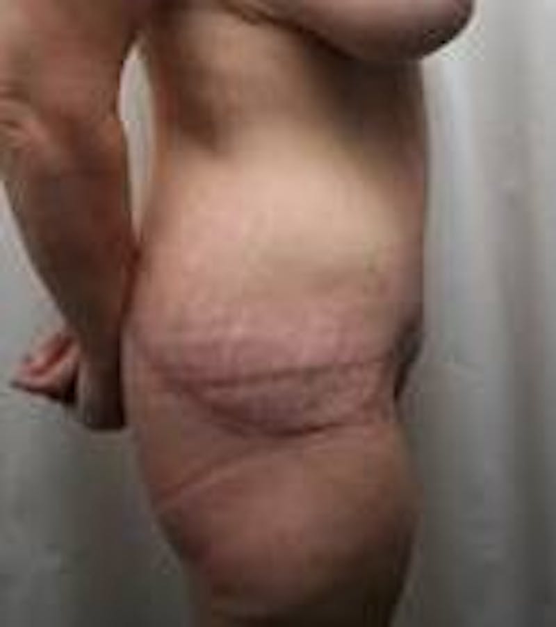 Lower Body Lift Before & After Gallery - Patient 272007 - Image 4 - Scott Chapin, MD