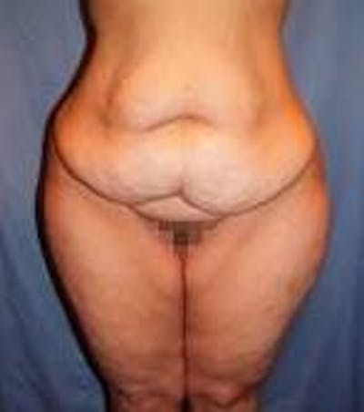 Lower Body Lift Before & After Gallery - Patient 418294 - Image 1 - Scott Chapin, MD