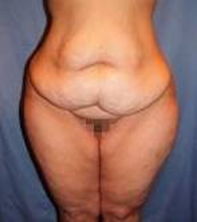 Lower Body Lift Before & After Gallery - Patient 418294 - Image 1 - Scott Chapin, MD