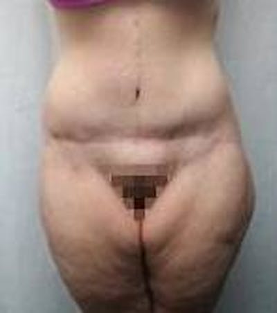 Lower Body Lift Before & After Gallery - Patient 418294 - Image 2 - Scott Chapin, MD