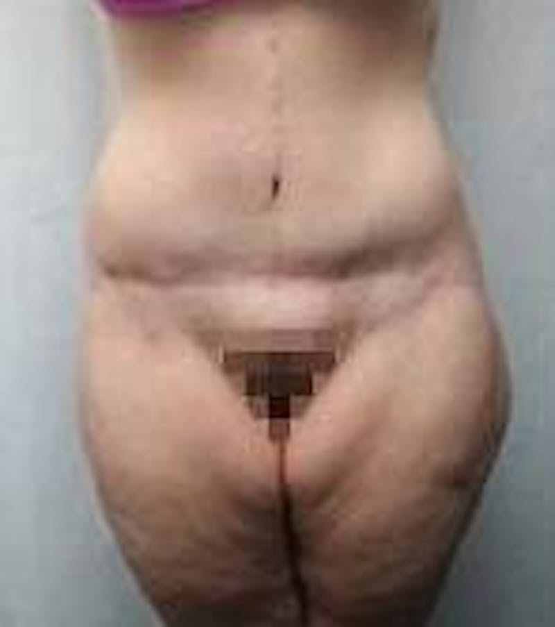 Lower Body Lift Before & After Gallery - Patient 418294 - Image 2 - Scott Chapin, MD