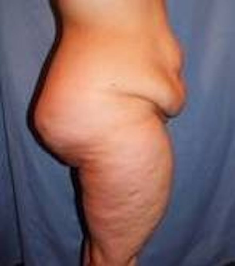 Lower Body Lift Before & After Gallery - Patient 418294 - Image 3 - Scott Chapin, MD