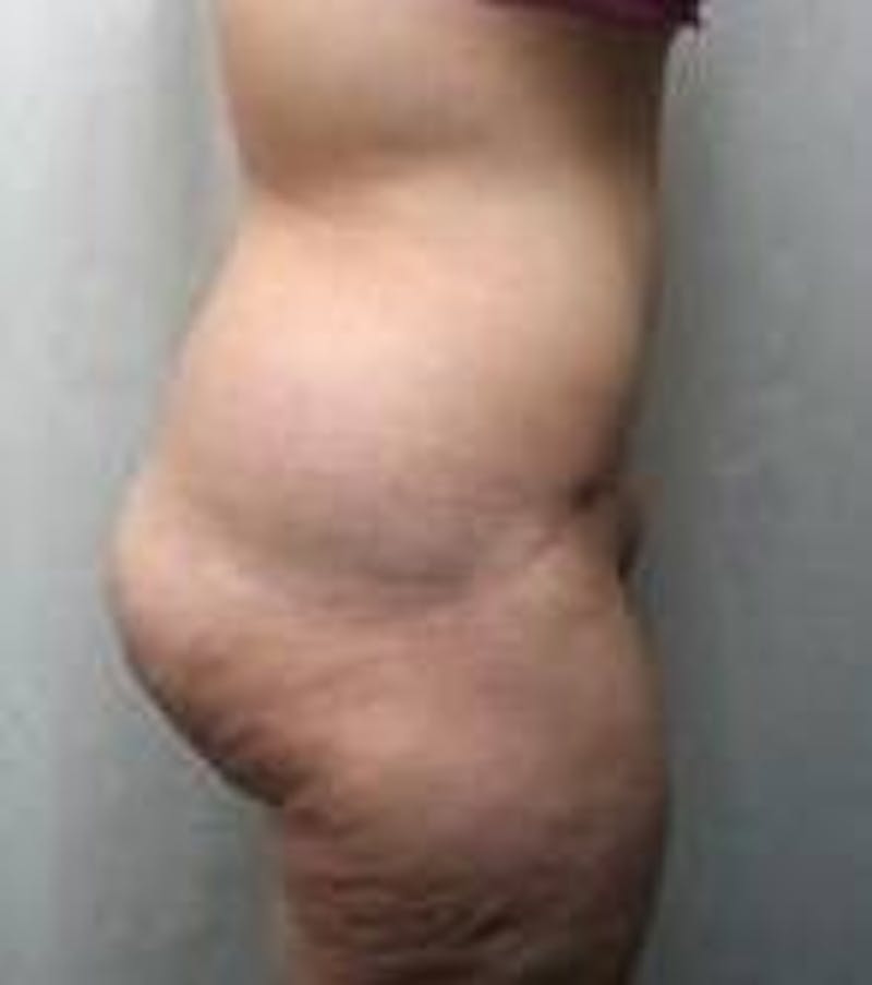 Lower Body Lift Before & After Gallery - Patient 418294 - Image 4 - Scott Chapin, MD