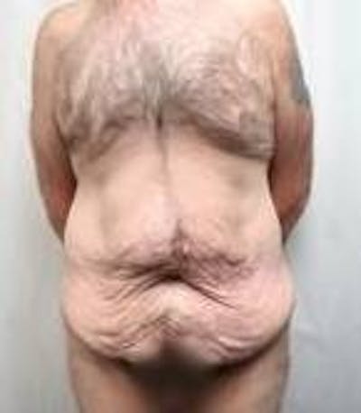 Lower Body Lift Before & After Gallery - Patient 918082 - Image 1 - Scott Chapin, MD