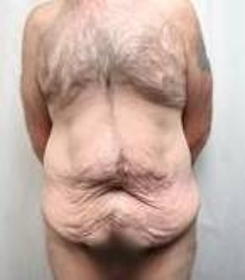 Lower Body Lift Before & After Gallery - Patient 918082 - Image 1 - Scott Chapin, MD