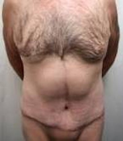 Lower Body Lift Before & After Gallery - Patient 918082 - Image 2 - Scott Chapin, MD