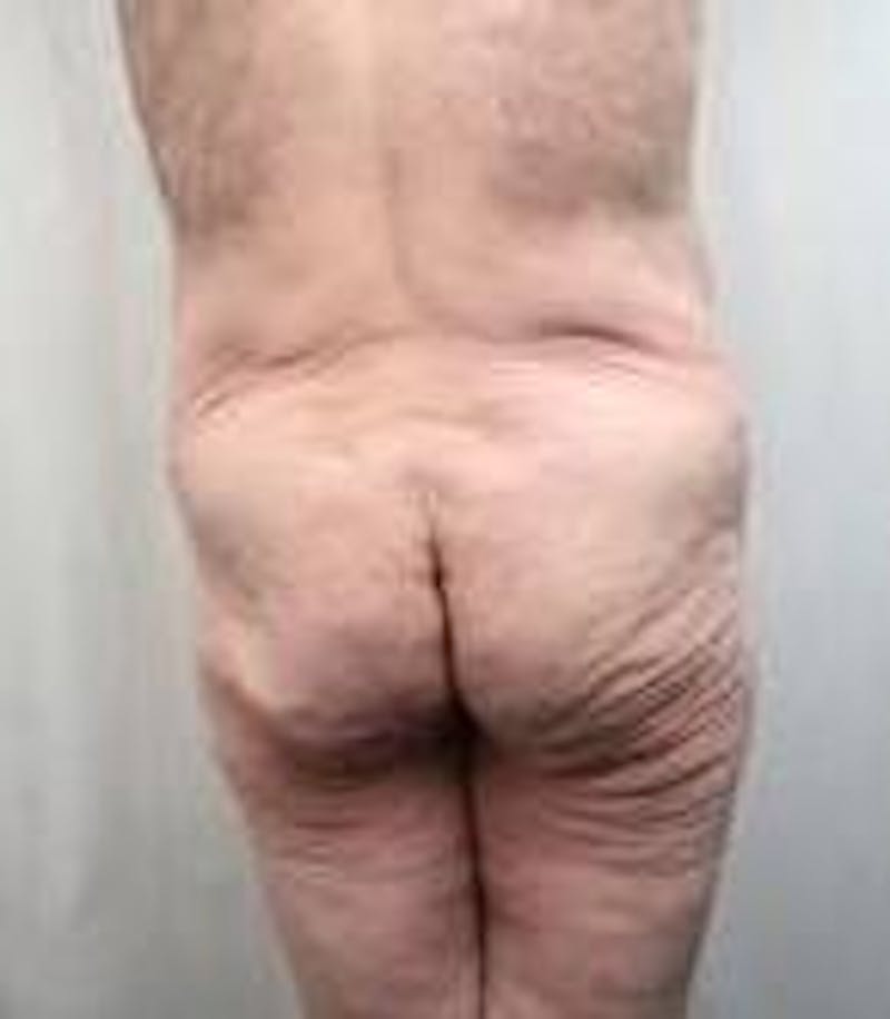 Lower Body Lift Before & After Gallery - Patient 918082 - Image 3 - Scott Chapin, MD