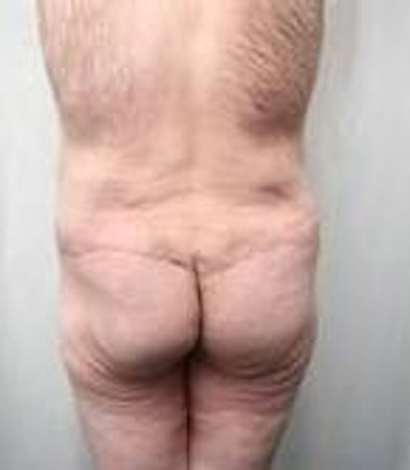 Lower Body Lift Before & After Gallery - Patient 918082 - Image 4 - Scott Chapin, MD