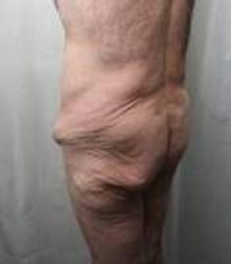 Lower Body Lift Before & After Gallery - Patient 918082 - Image 5 - Scott Chapin, MD