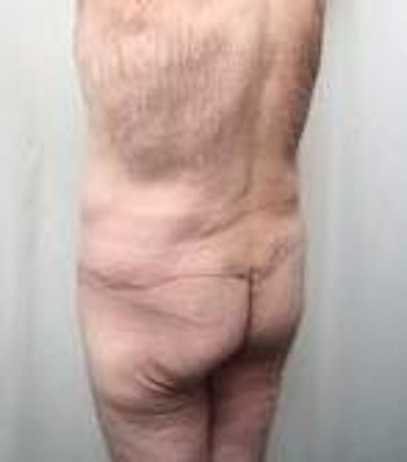 Lower Body Lift Before & After Gallery - Patient 918082 - Image 6 - Scott Chapin, MD