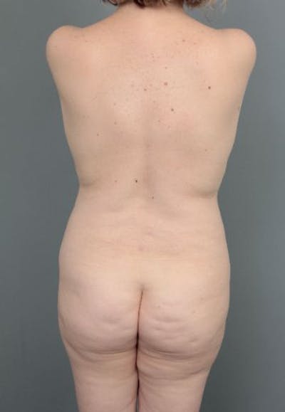 Brazilian Butt Lift Before & After Gallery - Patient 240852 - Image 1 - Scott Chapin, MD