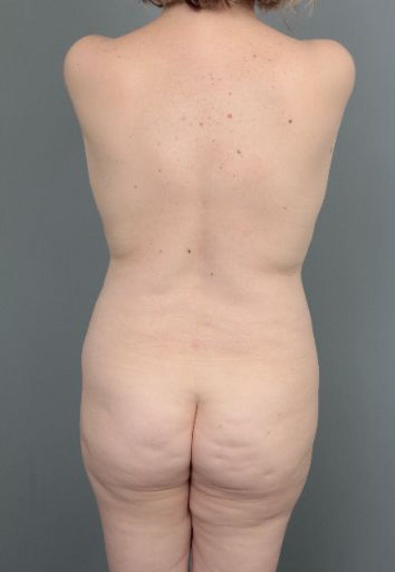Brazilian Butt Lift Before & After Gallery - Patient 240852 - Image 1 - Scott Chapin, MD