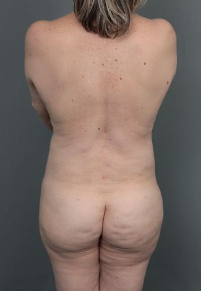 Brazilian Butt Lift Before & After Gallery - Patient 240852 - Image 2 - Scott Chapin, MD