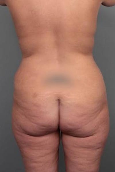 Brazilian Butt Lift Before & After Gallery - Patient 299630 - Image 1 - Scott Chapin, MD