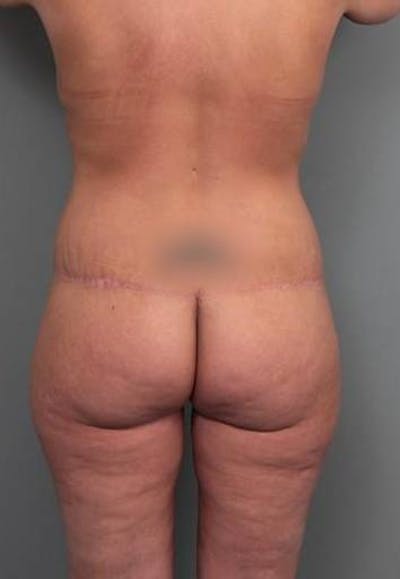 Brazilian Butt Lift Before & After Gallery - Patient 299630 - Image 2 - Scott Chapin, MD
