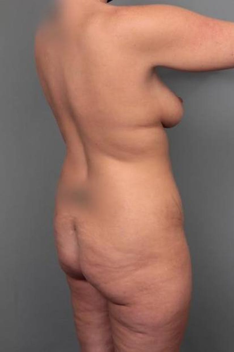 Brazilian Butt Lift Before & After Gallery - Patient 299630 - Image 3 - Scott Chapin, MD
