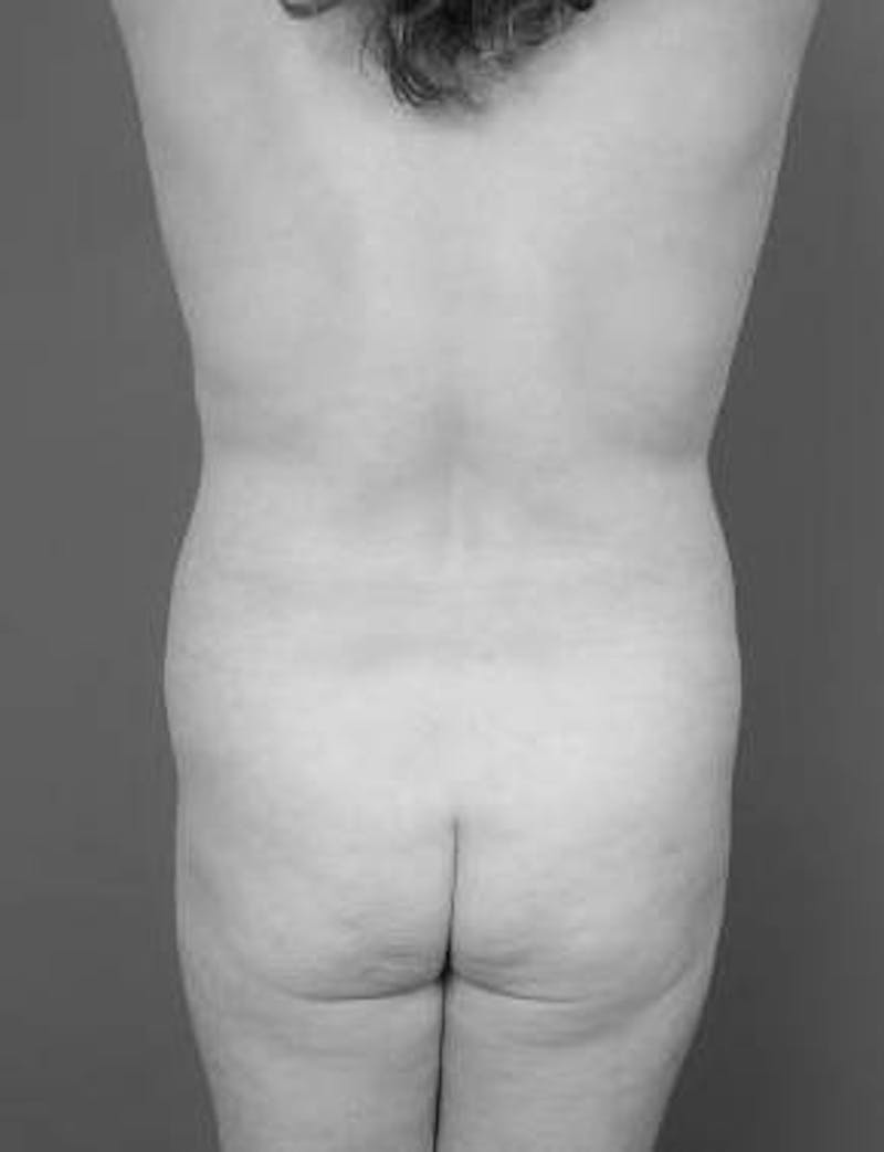 Brazilian Butt Lift Before & After Gallery - Patient 188759 - Image 1 - Scott Chapin, MD