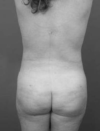 Brazilian Butt Lift Before & After Gallery - Patient 188759 - Image 2 - Scott Chapin, MD
