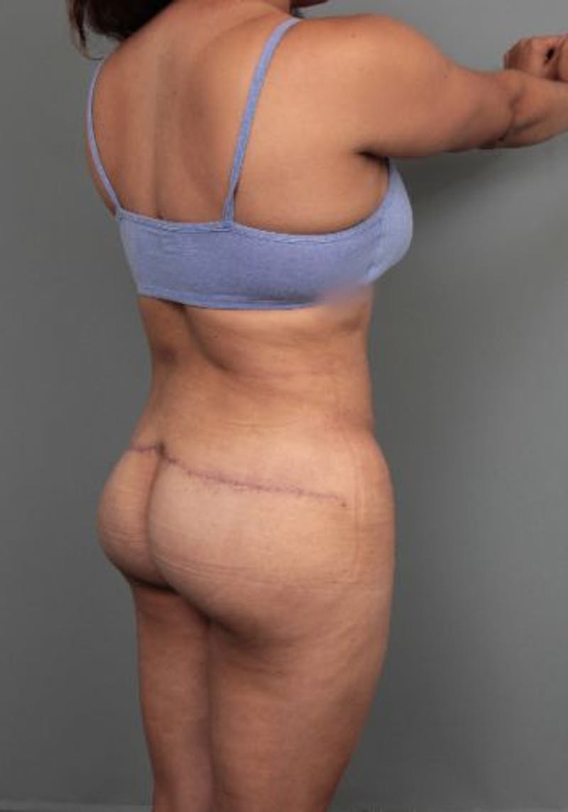 Thigh/Buttock Lift Before & After Gallery - Patient 234703 - Image 1 - Scott Chapin, MD