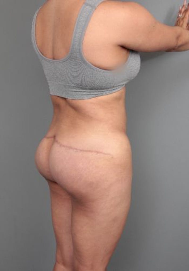 Thigh/Buttock Lift Before & After Gallery - Patient 234703 - Image 2 - Scott Chapin, MD