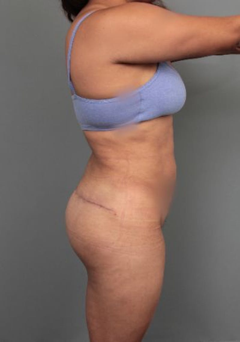 Thigh/Buttock Lift Before & After Gallery - Patient 234703 - Image 3 - Scott Chapin, MD