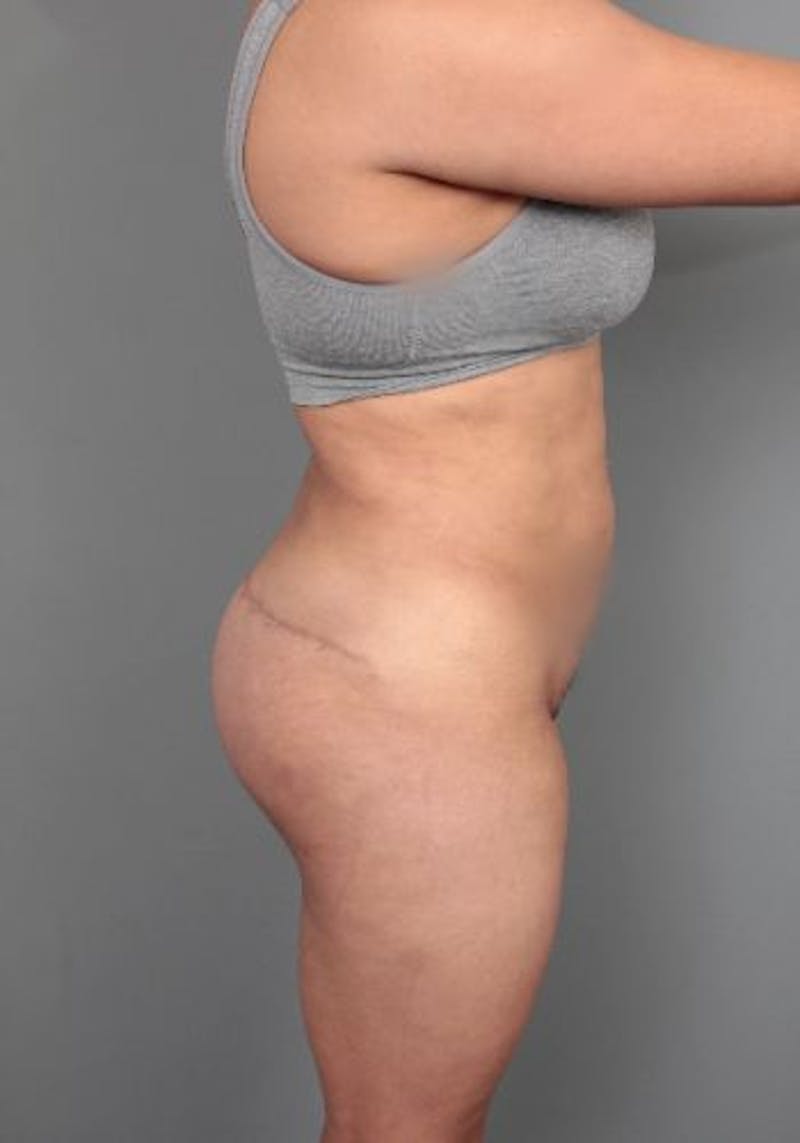 Thigh/Buttock Lift Before & After Gallery - Patient 234703 - Image 4 - Scott Chapin, MD