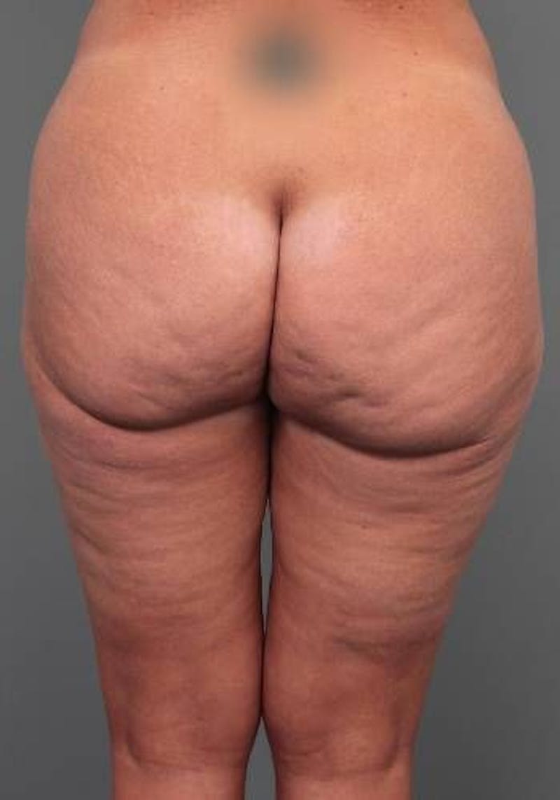 Thigh/Buttock Lift Before & After Gallery - Patient 223187 - Image 1 - Scott Chapin, MD