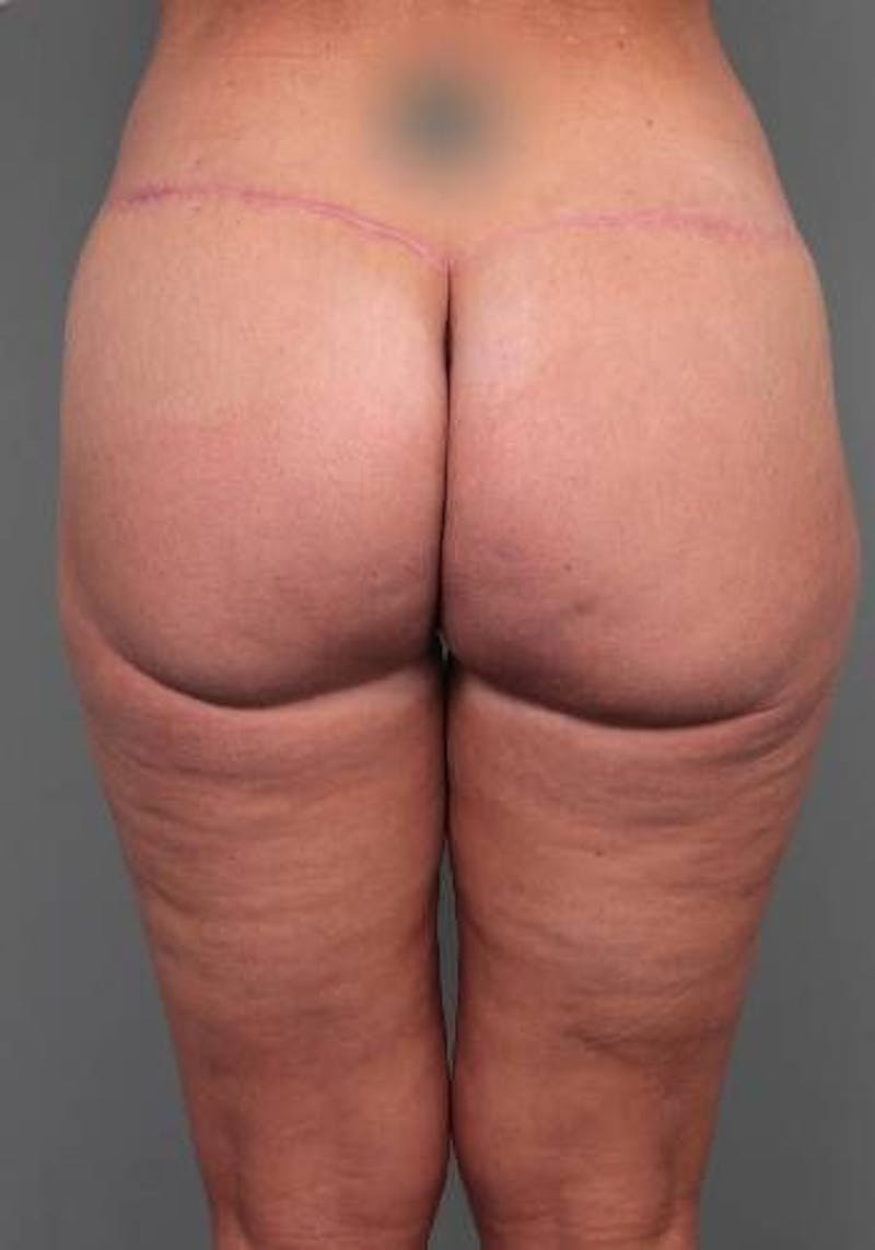 Thigh/Buttock Lift Before & After Gallery - Patient 223187 - Image 2 - Scott Chapin, MD