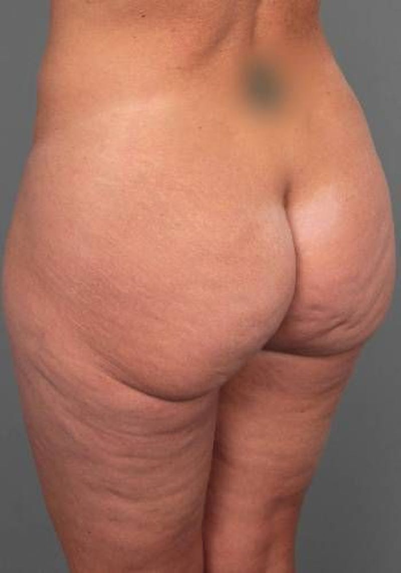 Thigh/Buttock Lift Before & After Gallery - Patient 223187 - Image 3 - Scott Chapin, MD