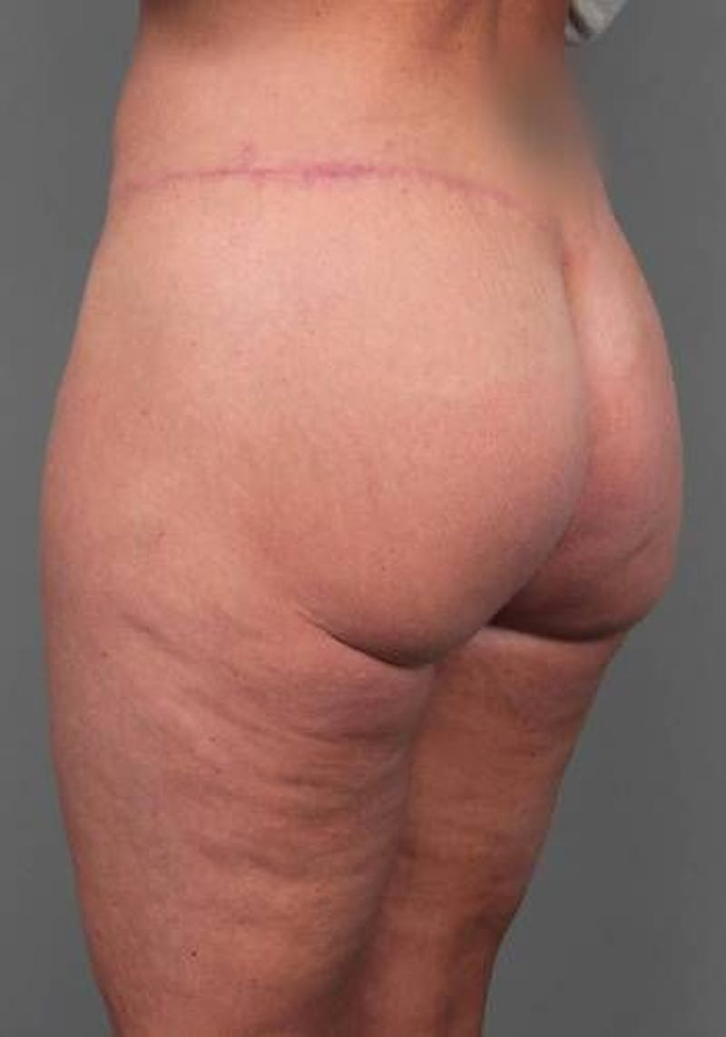 Thigh/Buttock Lift Before & After Gallery - Patient 223187 - Image 4 - Scott Chapin, MD