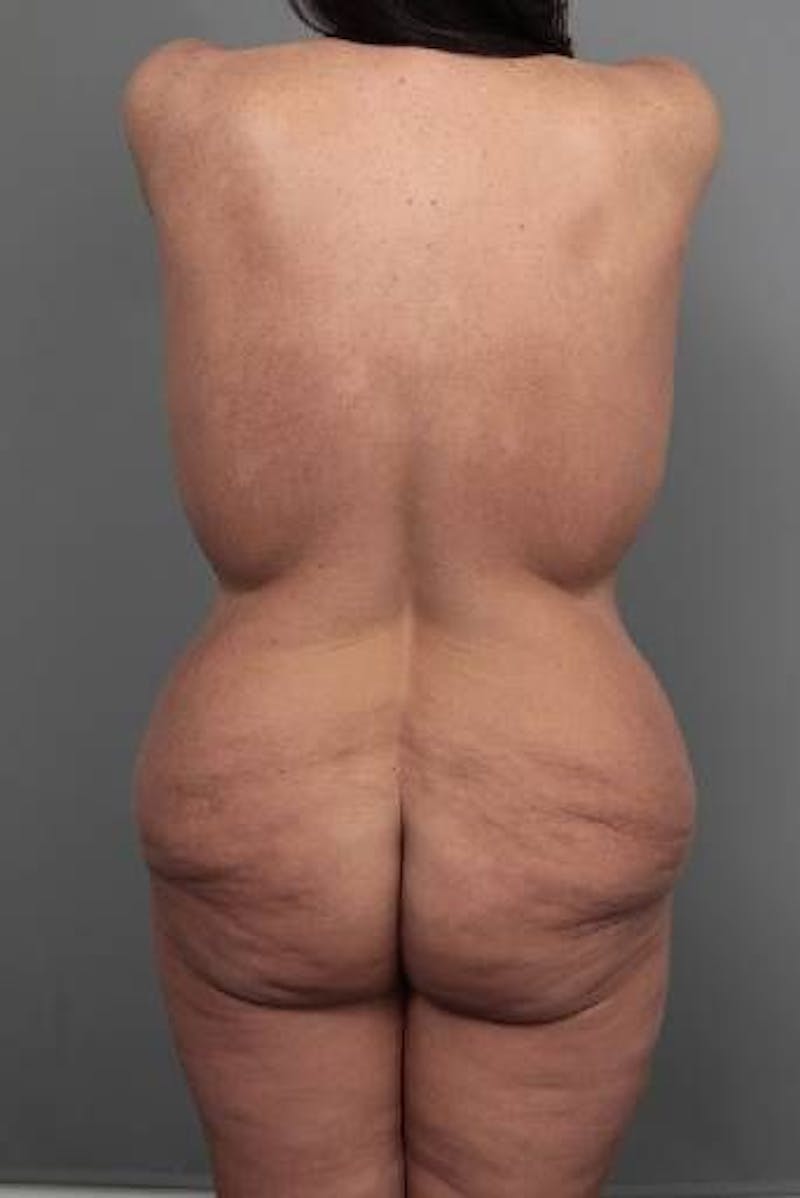 Thigh/Buttock Lift Before & After Gallery - Patient 366336 - Image 1 - Scott Chapin, MD