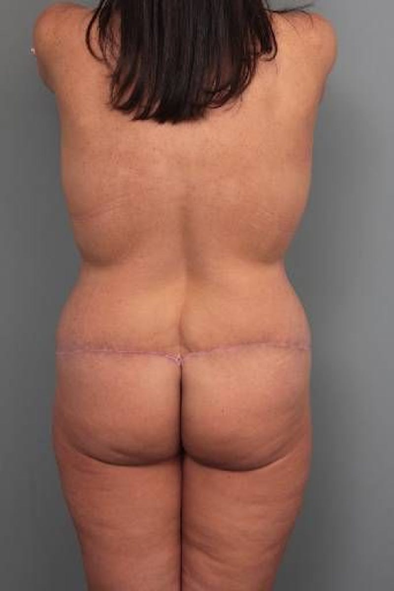Thigh/Buttock Lift Before & After Gallery - Patient 366336 - Image 2 - Scott Chapin, MD