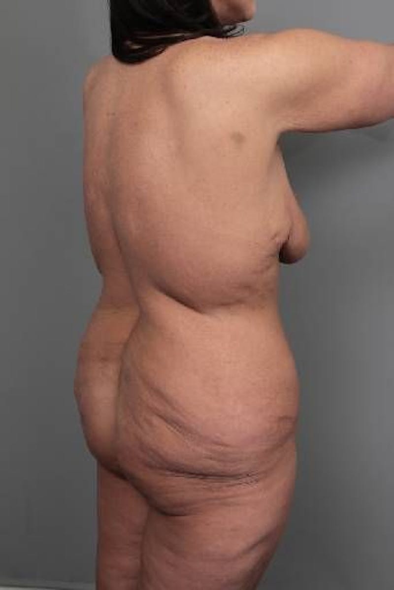 Thigh/Buttock Lift Before & After Gallery - Patient 366336 - Image 3 - Scott Chapin, MD
